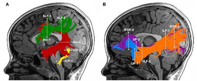 White Matter Plasticity in Reading-Related Pathways Differs in Children Born Preterm and at Term: A Longitudinal Analysis